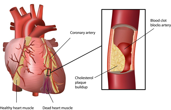 Understanding cardiovascular disease-Types of cardiovascular disease