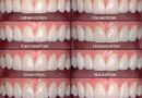 Understanding Insurance Coverage for Veneers: What You Need to Know