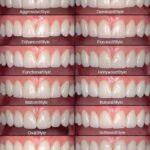 Understanding Insurance Coverage for Veneers: What You Need to Know